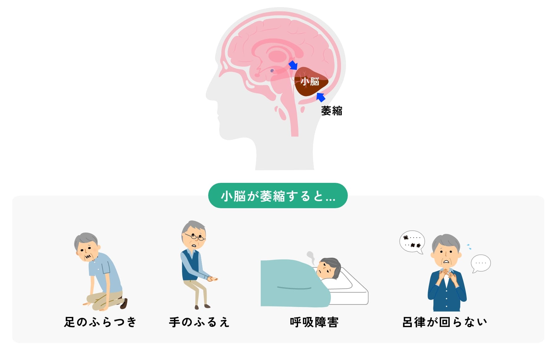 小脳は後頭部の下方に位置します。小脳が萎縮すると「足のふらつき」「手の震え」「呼吸障害」そして「呂律が回らない」などの症状が現れます。